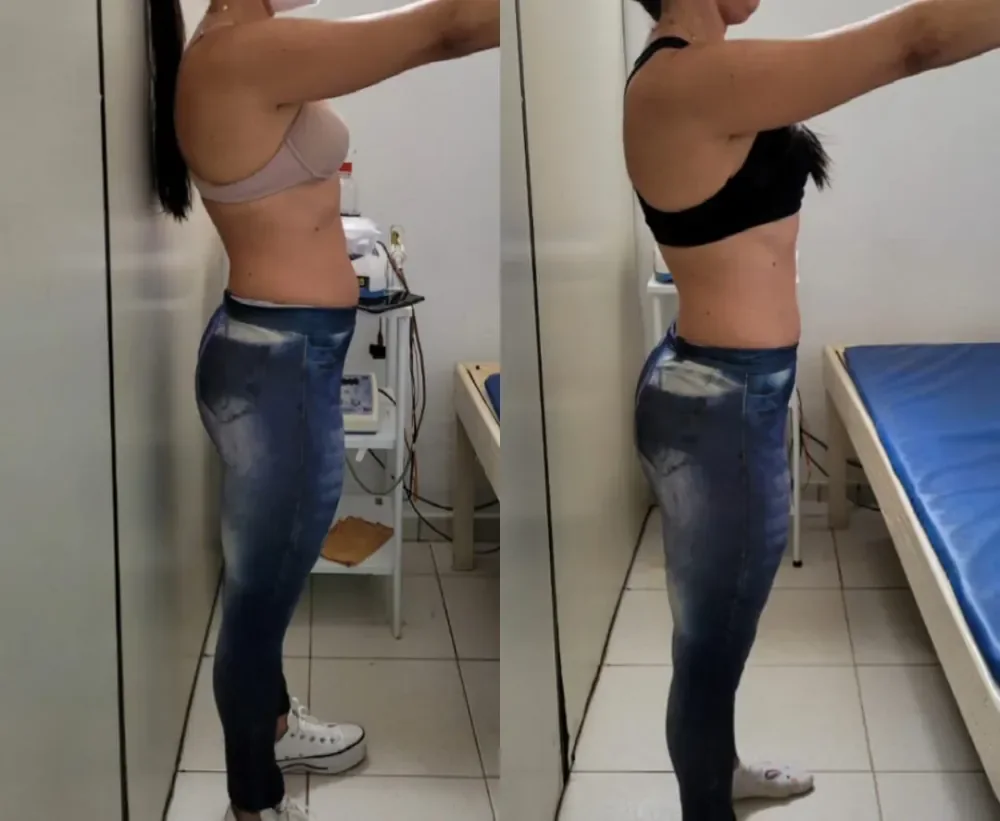 Antes e depois de Maristela com o Método Ativa & Afina.